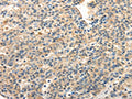 The image on the left is immunohistochemistry of paraffin-embedded Human liver cancer tissue using CSB-PA654024(TWIST2 Antibody) at dilution 1/20, on the right is treated with fusion protein. (Original magnification: ×200)