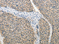 The image on the left is immunohistochemistry of paraffin-embedded Human liver cancer tissue using CSB-PA654216(ADHFE1 Antibody) at dilution 1/25, on the right is treated with synthetic peptide. (Original magnification: ×200)