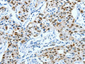 The image on the left is immunohistochemistry of paraffin-embedded Human lung cancer tissue using CSB-PA656958(JUN Antibody) at dilution 1/30, on the right is treated with fusion protein. (Original magnification: ×200)