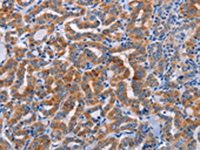 The image on the left is immunohistochemistry of paraffin-embedded Human thyroid cancer tissue using CSB-PA657688(ALG12 Antibody) at dilution 1/20, on the right is treated with fusion protein. (Original magnification: ×200)
