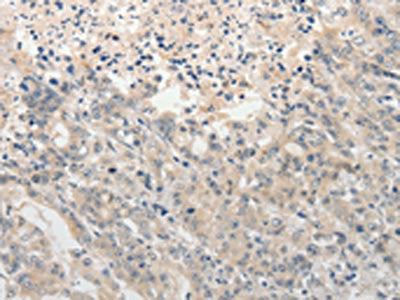 The image on the left is immunohistochemistry of paraffin-embedded Human gastic cancer tissue using CSB-PA657730(ADAMTS6 Antibody) at dilution 1/15, on the right is treated with synthetic peptide. (Original magnification: ×200)