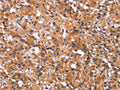 The image on the left is immunohistochemistry of paraffin-embedded Human thyroid cancer tissue using CSB-PA657855(MAPK11  Antibody) at dilution 1/30, on the right is treated with synthetic peptide. (Original magnification: ×200)