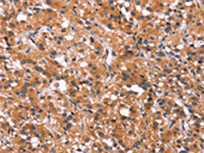 The image on the left is immunohistochemistry of paraffin-embedded Human thyroid cancer tissue using CSB-PA657855(MAPK11  Antibody) at dilution 1/30, on the right is treated with synthetic peptide. (Original magnification: ×200)
