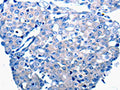 The image on the left is immunohistochemistry of paraffin-embedded Human breast cancer tissue using CSB-PA662351(CCL2 Antibody) at dilution 1/50, on the right is treated with synthetic peptide. (Original magnification: ×200)