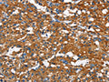 The image on the left is immunohistochemistry of paraffin-embedded Human thyroid cancer tissue using CSB-PA664999(CAMK1D Antibody) at dilution 1/50, on the right is treated with fusion protein. (Original magnification: ×200)