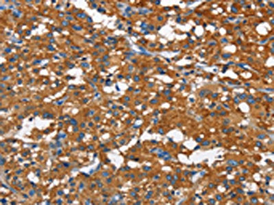 The image on the left is immunohistochemistry of paraffin-embedded Human thyroid cancer tissue using CSB-PA664999(CAMK1D Antibody) at dilution 1/50, on the right is treated with fusion protein. (Original magnification: ×200)