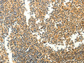 The image on the left is immunohistochemistry of paraffin-embedded Human tonsil tissue using CSB-PA665912(MYH7 Antibody) at dilution 1/20, on the right is treated with fusion protein. (Original magnification: ×200)