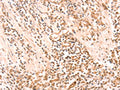 The image on the left is immunohistochemistry of paraffin-embedded Human gastic cancer tissue using CSB-PA665979(AMD1 Antibody) at dilution 1/20, on the right is treated with synthetic peptide. (Original magnification: ×200)