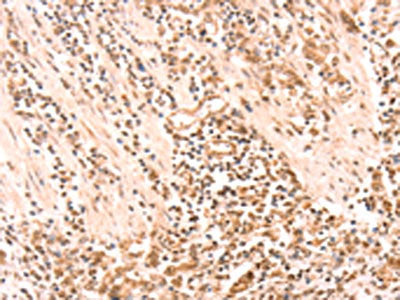 The image on the left is immunohistochemistry of paraffin-embedded Human gastic cancer tissue using CSB-PA665979(AMD1 Antibody) at dilution 1/20, on the right is treated with synthetic peptide. (Original magnification: ×200)