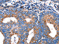 The image on the left is immunohistochemistry of paraffin-embedded Human cervical cancer tissue using CSB-PA668039(MERTK Antibody) at dilution 1/13, on the right is treated with fusion protein. (Original magnification: ×200)