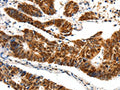 The image on the left is immunohistochemistry of paraffin-embedded Human colon cancer tissue using CSB-PA671453(SP1 Antibody) at dilution 1/40, on the right is treated with synthetic peptide. (Original magnification: ×200)