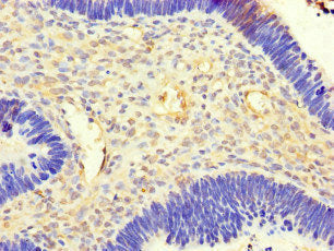 Immunohistochemistry of paraffin-embedded human ovarian cancer using CSB-PA674579LA01HU at dilution of 1:100