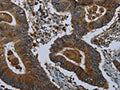 The image on the left is immunohistochemistry of paraffin-embedded Human colon cancer tissue using CSB-PA676168(GLUL Antibody) at dilution 1/60, on the right is treated with fusion protein. (Original magnification: ×200)