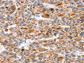 The image on the left is immunohistochemistry of paraffin-embedded Human liver cancer tissue using CSB-PA678002(KCNH6 Antibody) at dilution 1/30, on the right is treated with fusion protein. (Original magnification: ×200)