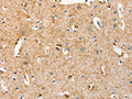 The image on the left is immunohistochemistry of paraffin-embedded Human brain tissue using CSB-PA678542(BRCA1 Antibody) at dilution 1/25, on the right is treated with fusion protein. (Original magnification: ×200)