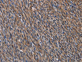 The image on the left is immunohistochemistry of paraffin-embedded Human sarcoma tissue using CSB-PA678801(LAMB3 Antibody) at dilution 1/40, on the right is treated with fusion protein. (Original magnification: ×200)