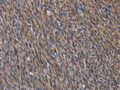 The image on the left is immunohistochemistry of paraffin-embedded Human sarcoma tissue using CSB-PA678801(LAMB3 Antibody) at dilution 1/40, on the right is treated with fusion protein. (Original magnification: ×200)