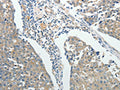 The image on the left is immunohistochemistry of paraffin-embedded Human breast cancer tissue using CSB-PA679461(ROCK1 Antibody) at dilution 1/25, on the right is treated with fusion protein. (Original magnification: ×200)