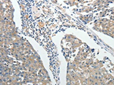 The image on the left is immunohistochemistry of paraffin-embedded Human breast cancer tissue using CSB-PA679461(ROCK1 Antibody) at dilution 1/25, on the right is treated with fusion protein. (Original magnification: ×200)