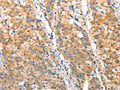 The image on the left is immunohistochemistry of paraffin-embedded Human gastic cancer tissue using CSB-PA679683(ST14 Antibody) at dilution 1/70, on the right is treated with fusion protein. (Original magnification: ×200)