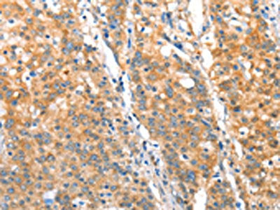 The image on the left is immunohistochemistry of paraffin-embedded Human gastic cancer tissue using CSB-PA679683(ST14 Antibody) at dilution 1/70, on the right is treated with fusion protein. (Original magnification: ×200)