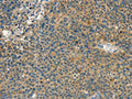 The image on the left is immunohistochemistry of paraffin-embedded Human liver cancer tissue using CSB-PA680635(CALCA Antibody) at dilution 1/60, on the right is treated with synthetic peptide. (Original magnification: ×200)