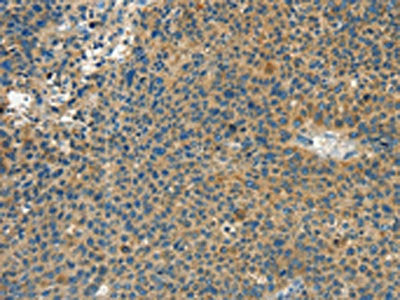 The image on the left is immunohistochemistry of paraffin-embedded Human liver cancer tissue using CSB-PA680635(CALCA Antibody) at dilution 1/60, on the right is treated with synthetic peptide. (Original magnification: ×200)