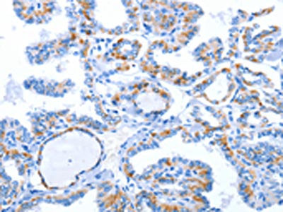The image on the left is immunohistochemistry of paraffin-embedded Human thyroid cancer tissue using CSB-PA682357(WNT1 Antibody) at dilution 1/50, on the right is treated with synthetic peptide. (Original magnification: ×200)