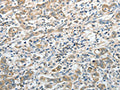The image on the left is immunohistochemistry of paraffin-embedded Human gastric cancer tissue using CSB-PA686209(PRMT2 Antibody) at dilution 1/20, on the right is treated with fusion protein. (Original magnification: ×200)