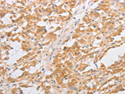The image on the left is immunohistochemistry of paraffin-embedded Human thyroid cancer tissue using CSB-PA687184(CDKN2AIP Antibody) at dilution 1/40, on the right is treated with fusion protein. (Original magnification: ×200)