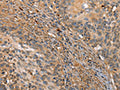 The image on the left is immunohistochemistry of paraffin-embedded Human cervical cancer tissue using CSB-PA687442(HK3 Antibody) at dilution 1/40, on the right is treated with fusion protein. (Original magnification: ×200)