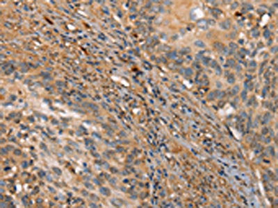 The image on the left is immunohistochemistry of paraffin-embedded Human cervical cancer tissue using CSB-PA687442(HK3 Antibody) at dilution 1/40, on the right is treated with fusion protein. (Original magnification: ×200)
