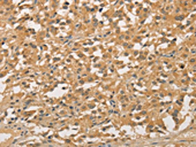The image on the left is immunohistochemistry of paraffin-embedded Human thyroid cancer tissue using CSB-PA690633(NFE2L1 Antibody) at dilution 1/20, on the right is treated with fusion protein. (Original magnification: ×200)