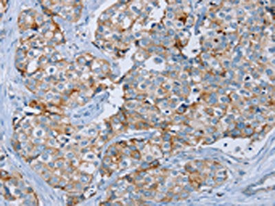 The image on the left is immunohistochemistry of paraffin-embedded Human breast cancer tissue using CSB-PA692815(MUC1 Antibody) at dilution 1/45, on the right is treated with synthetic peptide. (Original magnification: ×200)