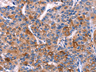 The image on the left is immunohistochemistry of paraffin-embedded Human liver cancer tissue using CSB-PA693441(DUSP13 Antibody) at dilution 1/60, on the right is treated with fusion protein. (Original magnification: ×200)