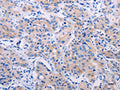 The image on the left is immunohistochemistry of paraffin-embedded Human lung cancer tissue using CSB-PA693559(AGT Antibody) at dilution 1/50, on the right is treated with synthetic peptide. (Original magnification: ×200)