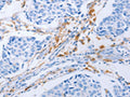 The image on the left is immunohistochemistry of paraffin-embedded Human lung cancer tissue using CSB-PA694004(LAIR1 Antibody) at dilution 1/25, on the right is treated with fusion protein. (Original magnification: ×200)