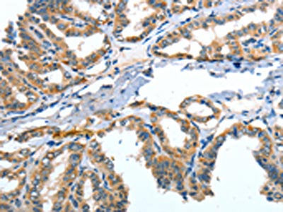 The image on the left is immunohistochemistry of paraffin-embedded Human thyroid cancer tissue using CSB-PA694467(ANGPT2 Antibody) at dilution 1/30, on the right is treated with fusion protein. (Original magnification: ×200)