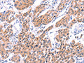 The image on the left is immunohistochemistry of paraffin-embedded Human lung cancer tissue using CSB-PA694547(STXBP2 Antibody) at dilution 1/20, on the right is treated with fusion protein. (Original magnification: ×200)