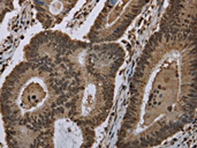The image on the left is immunohistochemistry of paraffin-embedded Human colon cancer tissue using CSB-PA694551(HIST1H2AH Antibody) at dilution 1/40, on the right is treated with fusion protein. (Original magnification: ×200)