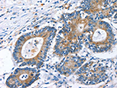 The image on the left is immunohistochemistry of paraffin-embedded Human colon cancer tissue using CSB-PA694669(RAF1 Antibody) at dilution 1/40, on the right is treated with fusion protein. (Original magnification: ×200)