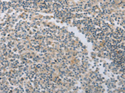 The image on the left is immunohistochemistry of paraffin-embedded Human tonsil tissue using CSB-PA695195(MAGED1 Antibody) at dilution 1/30, on the right is treated with fusion protein. (Original magnification: ×200)
