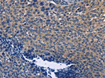 The image on the left is immunohistochemistry of paraffin-embedded Human cervical cancer tissue using CSB-PA695460(SYT17 Antibody) at dilution 1/60, on the right is treated with fusion protein. (Original magnification: ×200)