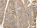 The image on the left is immunohistochemistry of paraffin-embedded Human liver cancer tissue using CSB-PA696260(TXN Antibody) at dilution 1/40, on the right is treated with synthetic peptide. (Original magnification: ×200)