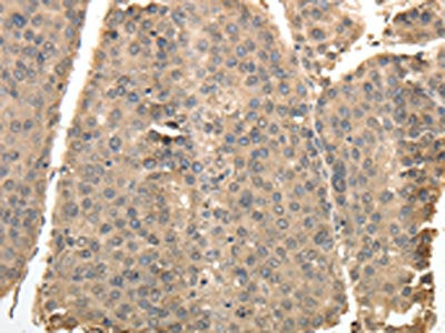 The image on the left is immunohistochemistry of paraffin-embedded Human liver cancer tissue using CSB-PA696260(TXN Antibody) at dilution 1/40, on the right is treated with synthetic peptide. (Original magnification: ×200)