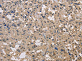 The image on the left is immunohistochemistry of paraffin-embedded Human thyroid cancer tissue using CSB-PA696333(DRG1 Antibody) at dilution 1/30, on the right is treated with fusion protein. (Original magnification: ×200)