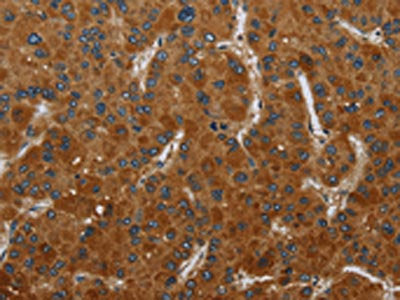 The image on the left is immunohistochemistry of paraffin-embedded Human liver cancer tissue using CSB-PA696449(CSH1 Antibody) at dilution 1/50, on the right is treated with fusion protein. (Original magnification: ×200)