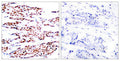 Immunohistochemical analysis of paraffin-embedded human breast carcinoma tissue using JunB(Phospho-Ser79) Antibody(left) or the same antibody preincubated with blocking peptide(right).