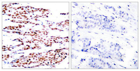 Immunohistochemical analysis of paraffin-embedded human breast carcinoma tissue using JunB(Phospho-Ser79) Antibody(left) or the same antibody preincubated with blocking peptide(right).