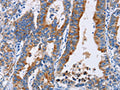The image on the left is immunohistochemistry of paraffin-embedded Human gastic cancer tissue using CSB-PA696568(ANXA4 Antibody) at dilution 1/25, on the right is treated with fusion protein. (Original magnification: ×200)